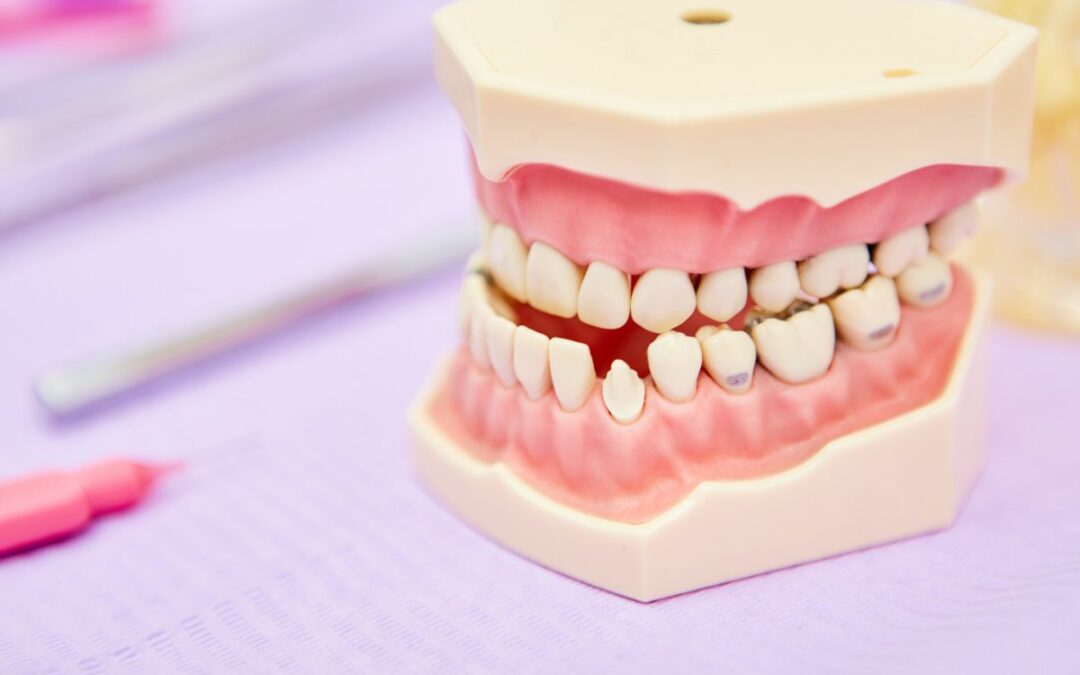 Malocclusione dentale: cos’è e come influisce sulla salute generale e trattamento