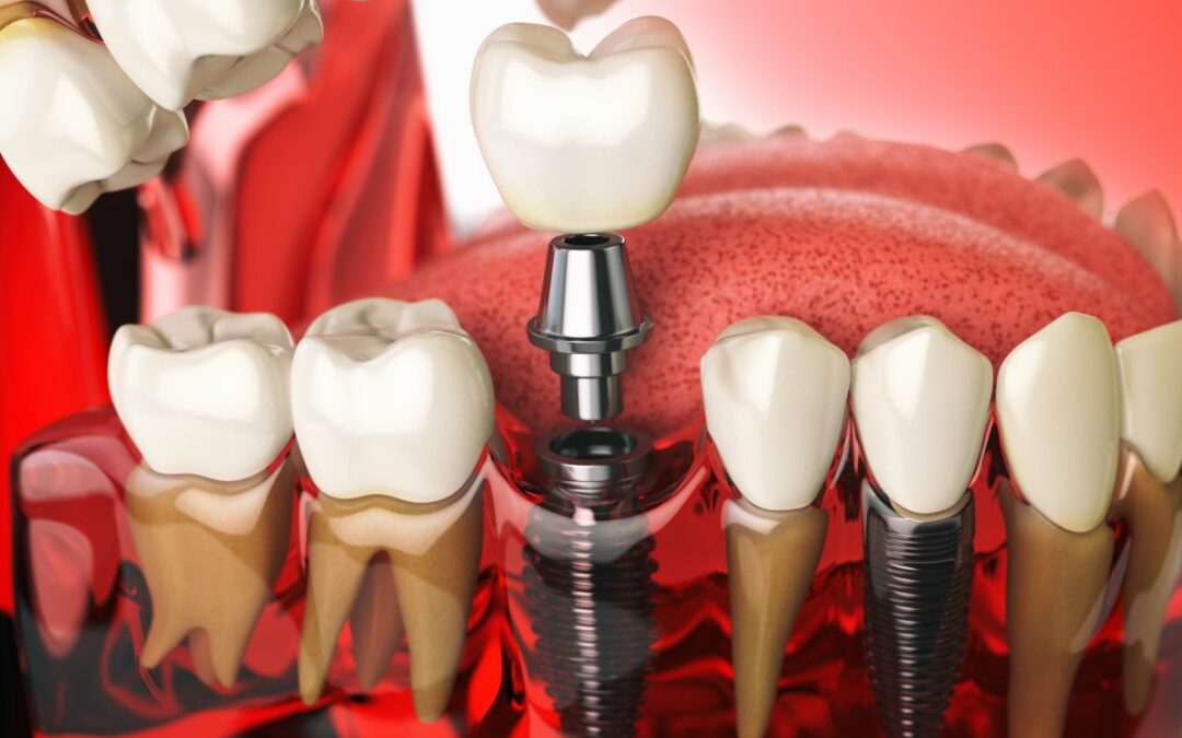Implantologia dentale: soluzioni per chi ha poco osso